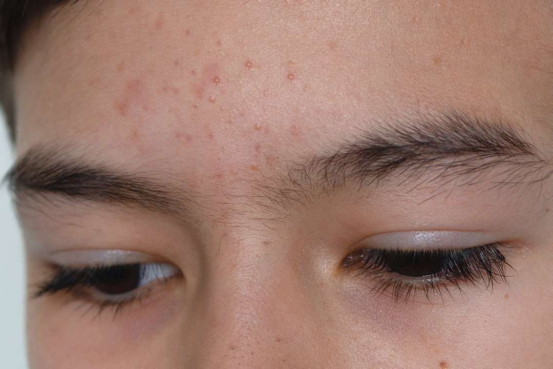 Super Efektif! 5 Tips Skincare untuk Fungal Acne Kamu skincare untuk fungal acne